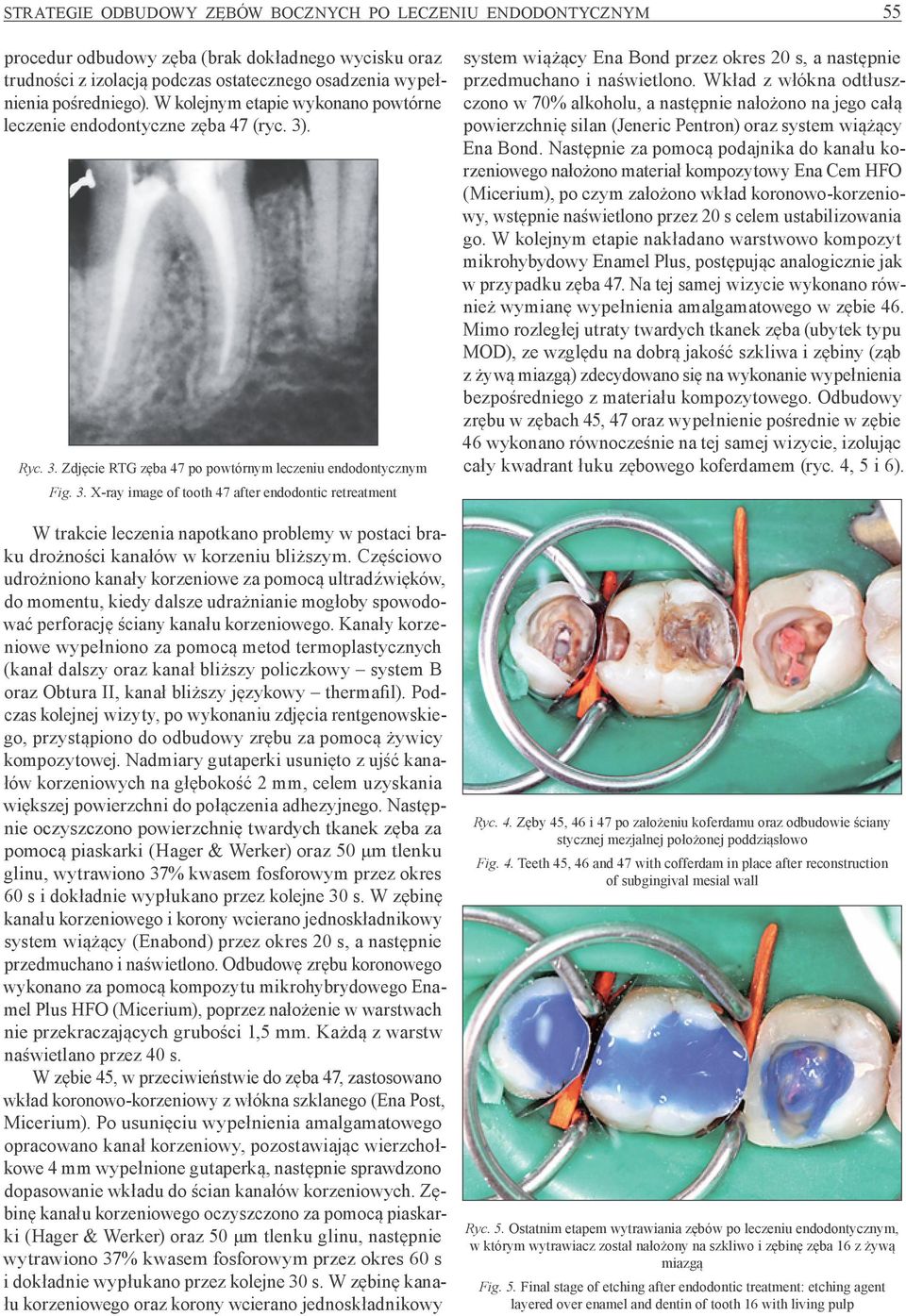 . Ryc. 3. Zdjęcie RTG zęba 47 po powtórnym leczeniu endodontycznym Fig. 3. X-ray image of tooth 47 after endodontic retreatment W trakcie leczenia napotkano problemy w postaci braku drożności kanałów w korzeniu bliższym.