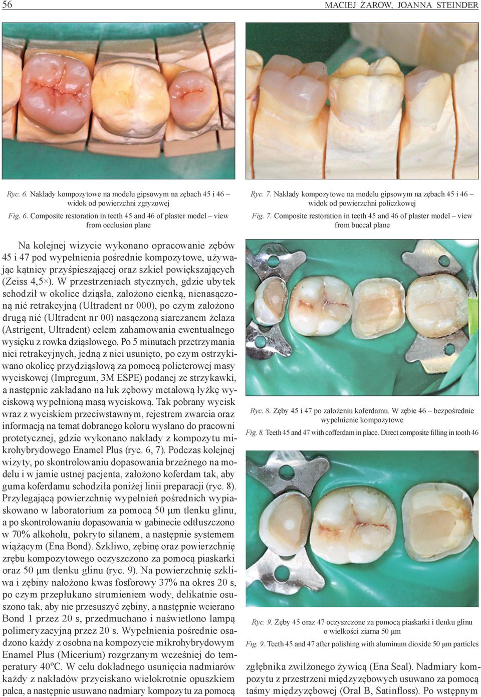 Composite restoration in teeth 45 and 46 of plaster model view from occlusion plane Na kolejnej wizycie wykonano opracowanie zębów 45 i 47 pod wypełnienia pośrednie kompozytowe, używając kątnicy