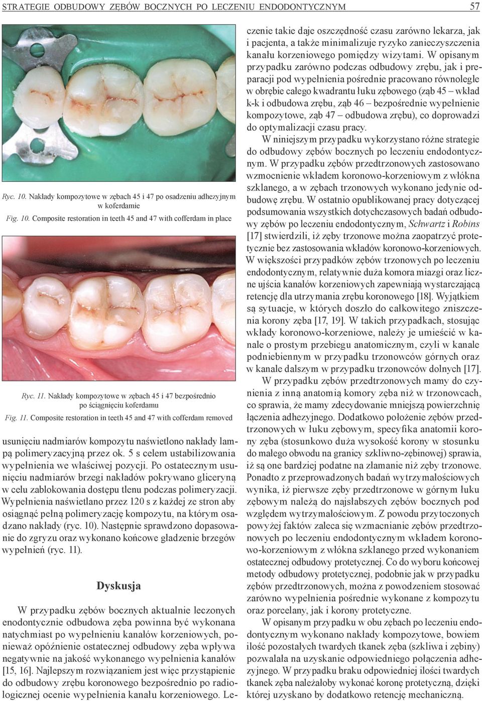 Composite restoration in teeth 45 and 47 with cofferdam removed usunięciu nadmiarów kompozytu naświetlono nakłady lampą polimeryzacyjną przez ok.