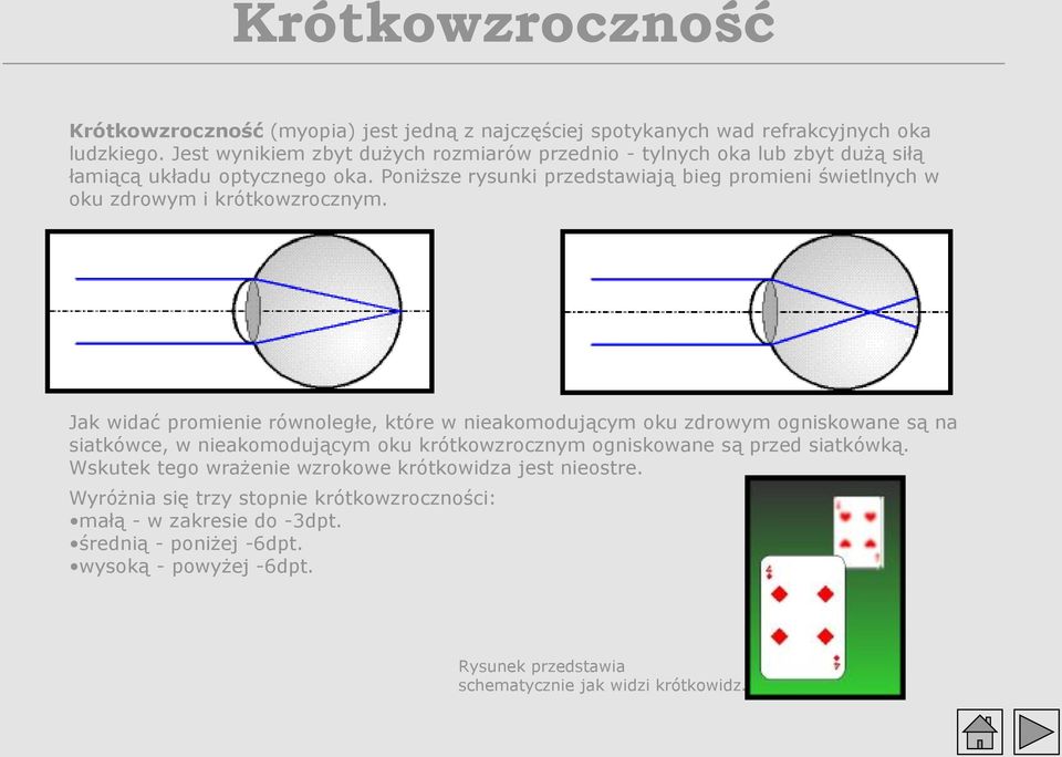 Poniższe rysunki przedstawiają bieg promieni świetlnych w oku zdrowym i krótkowzrocznym.