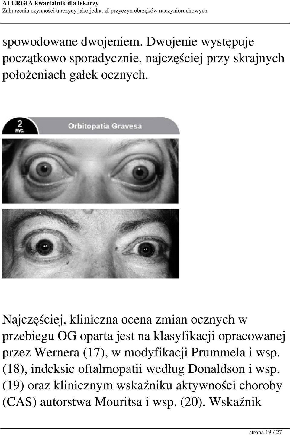 Najczęściej, kliniczna ocena zmian ocznych w przebiegu OG oparta jest na klasyfikacji opracowanej przez