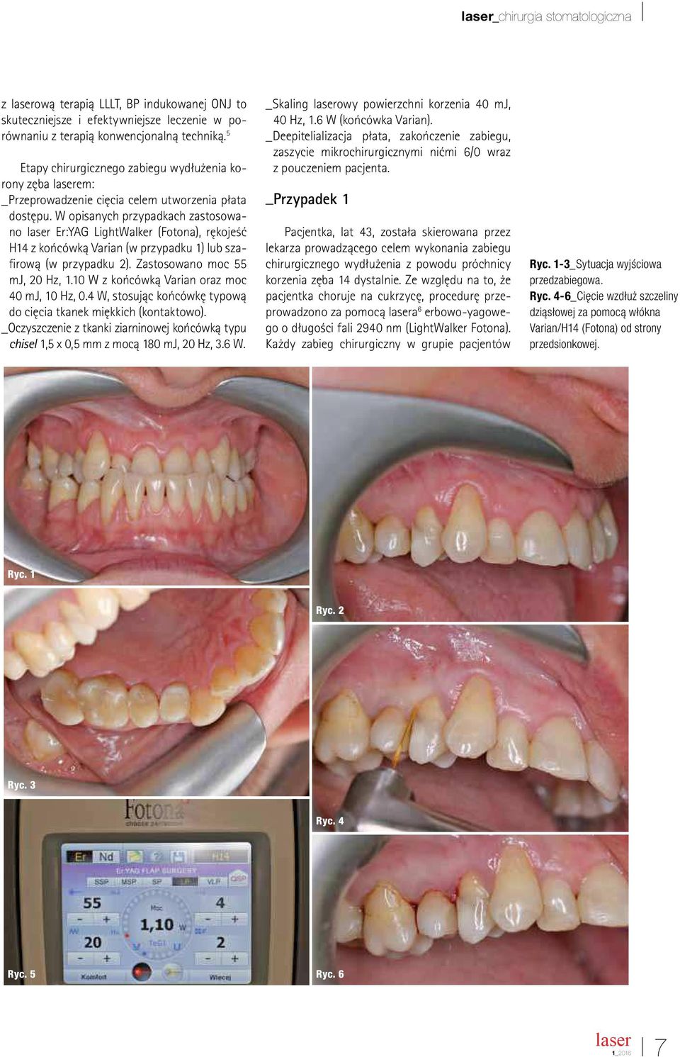 W opisanych przypadkach zastosowano Er:YAG LightWalker (Fotona), rękojeść H14 z końcówką Varian (w przypadku 1) lub szairową (w przypadku 2). Zastosowano moc 55 mj, 20 Hz, 1.