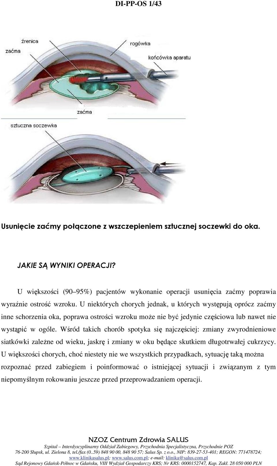 U niektórych chorych jednak, u których występują oprócz zaćmy inne schorzenia oka, poprawa ostrości wzroku może nie być jedynie częściowa lub nawet nie wystąpić w ogóle.