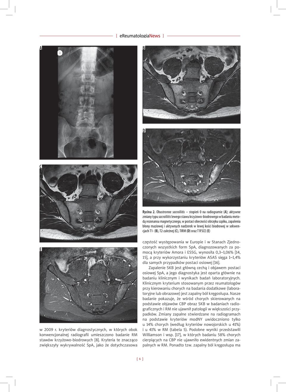 zapalenia błony maziowej i aktywnych nadżerek w lewej kości biodrowej w sekwencjach T1- (B), T2-zależnej (C), TIRM (D) oraz T1FSCE (E) E w 2009 r.