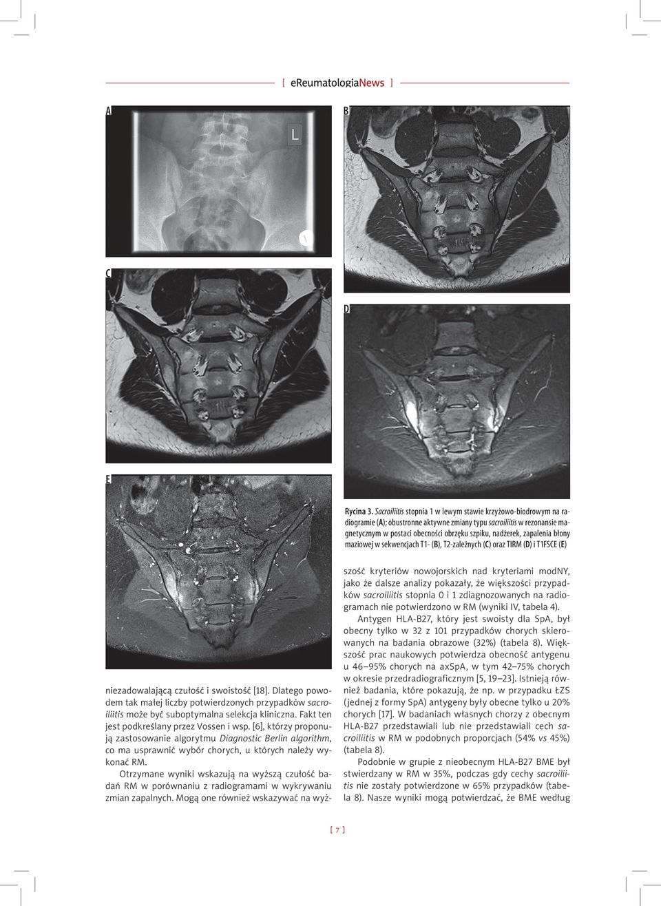zapalenia błony maziowej w sekwencjach T1- (B), T2-zależnych (C) oraz TIRM (D) i T1FSCE (E) niezadowalającą czułość i swoistość [18].