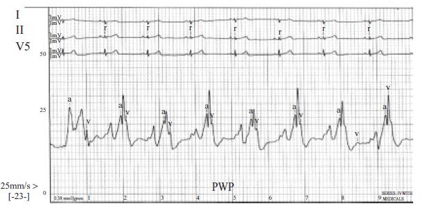 Nadciśnienie płucne spowodowane chorobą lewego serca, pozawłośniczkowe PCWP 15