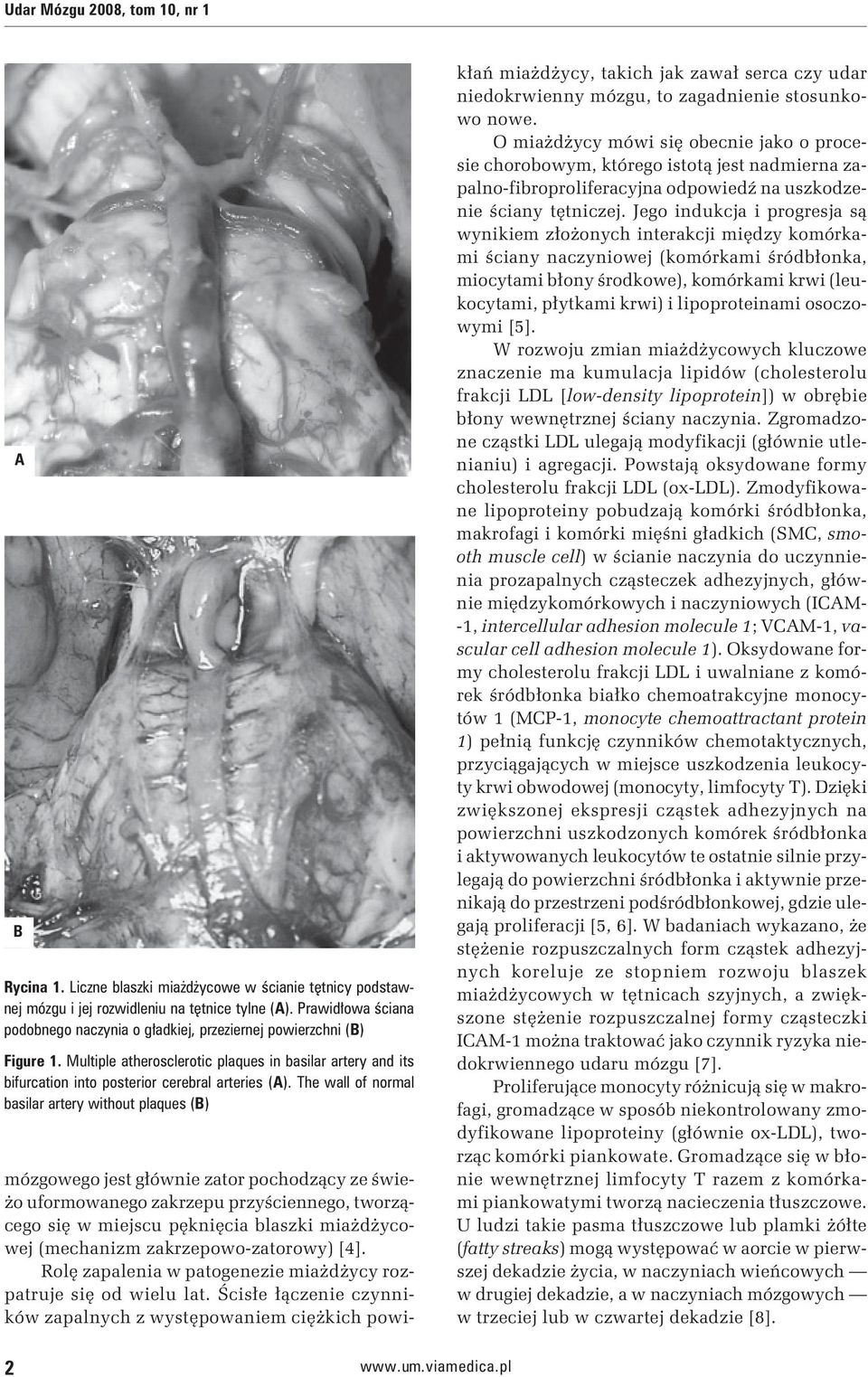 The wall of normal basilar artery without plaques (B) mózgowego jest głównie zator pochodzący ze świeżo uformowanego zakrzepu przyściennego, tworzącego się w miejscu pęknięcia blaszki miażdżycowej