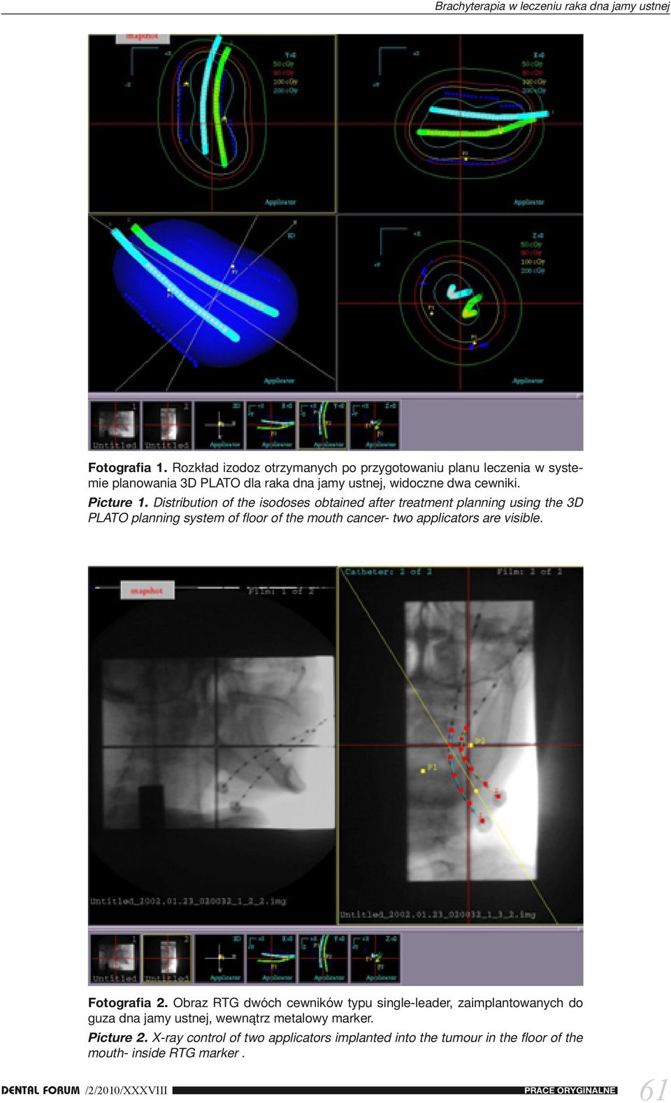 Distribution of the isodoses obtained after treatment planning using the 3D PLATO planning system of floor of the mouth cancer- two applicators are