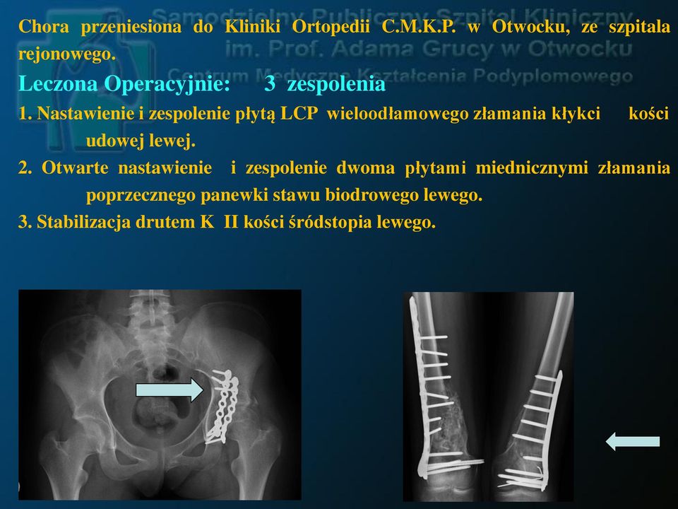 Nastawienie i zespolenie płytą LCP wieloodłamowego złamania kłykci kości udowej lewej. 2.