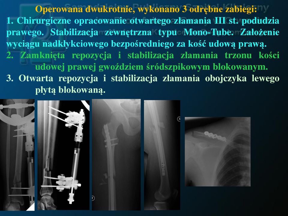 Założenie wyciągu nadkłykciowego bezpośredniego za kość udową prawą. 2.