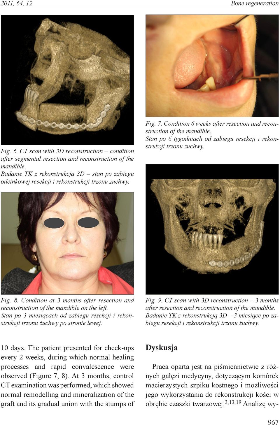 Stan po 6 tygodniach od zabiegu resekcji i rekonstrukcji trzonu żuchwy. Fig. 8. Condition at 3 months after resection and reconstruction of the mandible on the left.