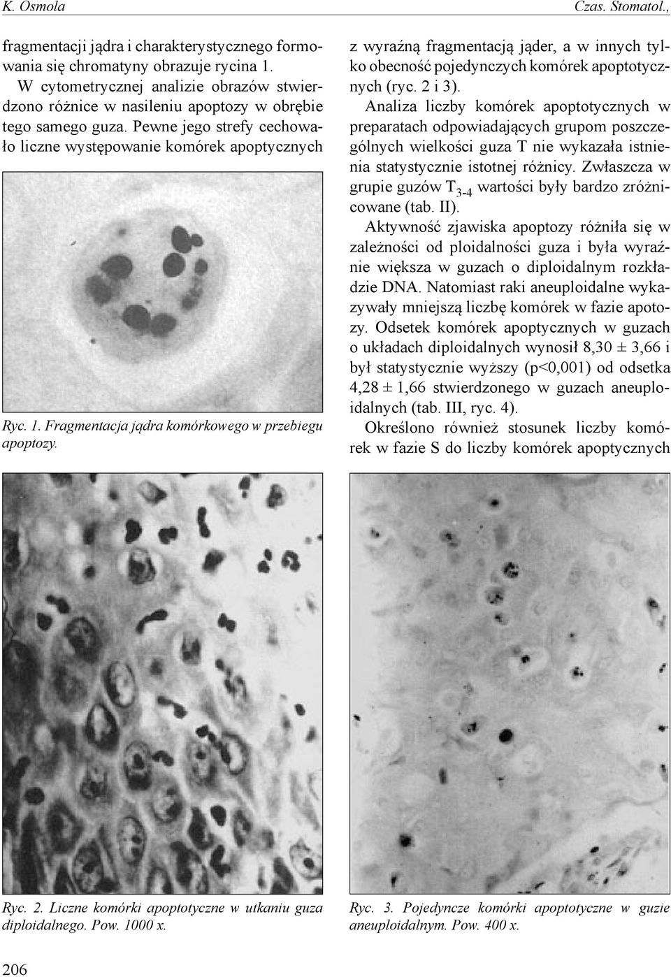 Fragmentacja jądra komórkowego w przebiegu apoptozy. z wyraźną fragmentacją jąder, a w innych tylko obecność pojedynczych komórek apoptotycznych (ryc. 2 i 3).