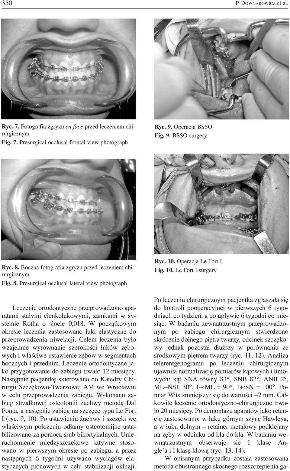 Presurgical occlusal lateral view photograph Leczenie ortodontyczne przeprowadzono apa ratami stałymi cienkołukowymi, zamkami w sy stemie Rotha o slocie 0,018.