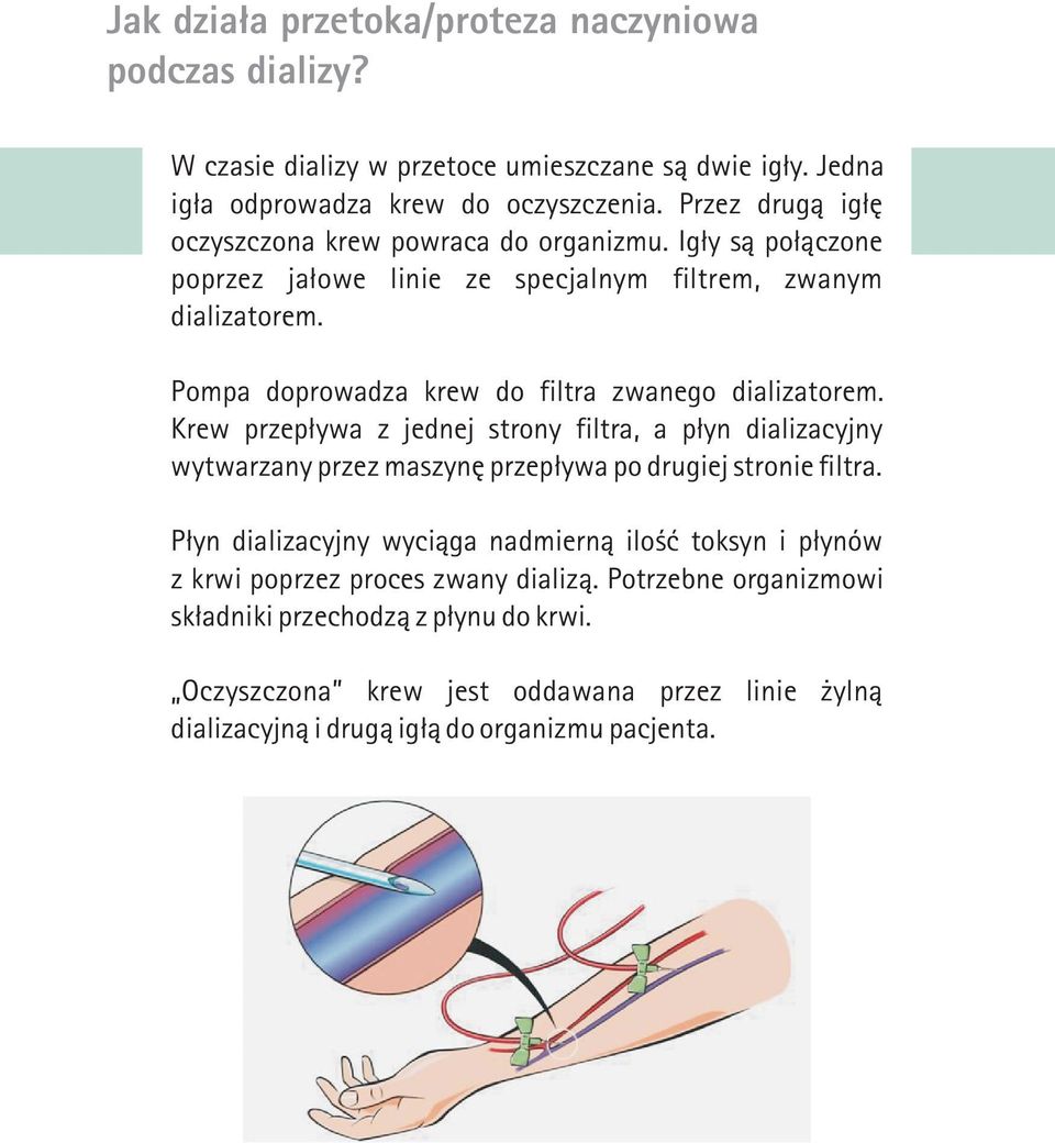 Pompa doprowadza krew do filtra zwanego dializatorem. Krew przep³ywa z jednej strony filtra, a p³yn dializacyjny wytwarzany przez maszynê przep³ywa po drugiej stronie filtra.