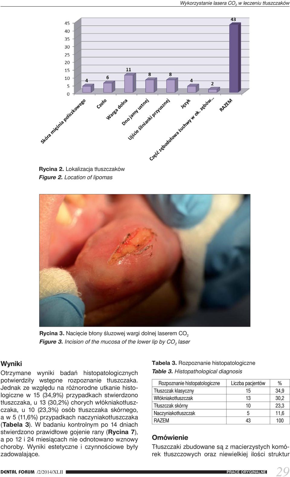 Jednak ze względu na różnorodne utkanie histologiczne w 15 (34,9%) przypadkach stwierdzono tłuszczaka, u 13 (30,2%) chorych włókniakotłuszczaka, u 10 (23,3%) osób tłuszczaka skórnego, a w 5 (11,6%)