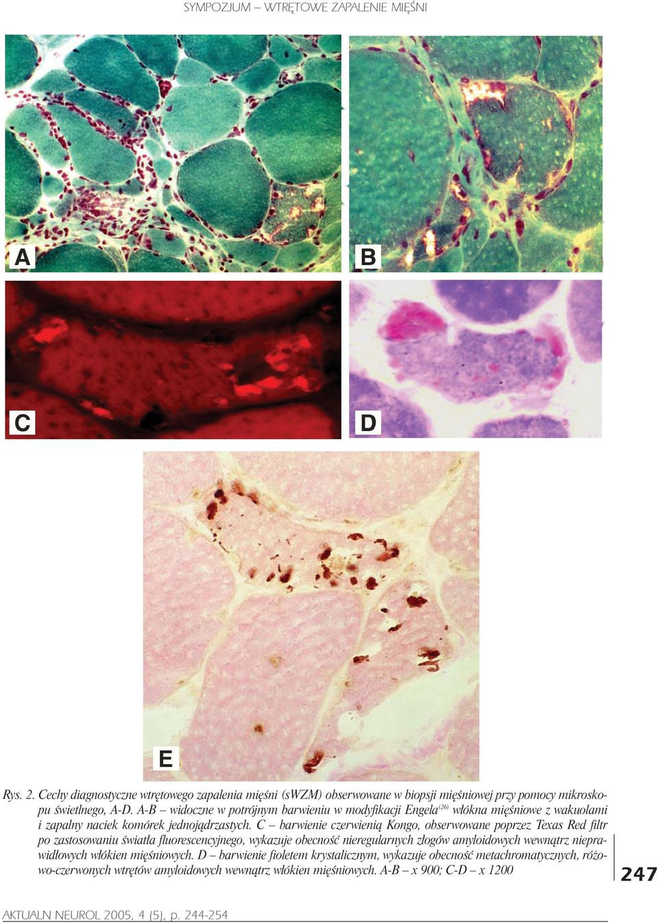 A-B widoczne w potrójnym barwieniu w modyfikacji Engela(26) w³ókna miêœniowe z wakuolami i zapalny naciek komórek jednoj¹drzastych.