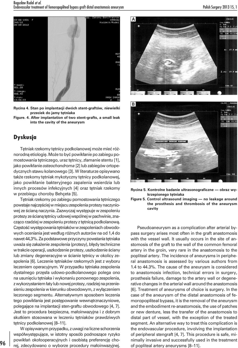 After implantation of two stent-grafts, a small leak into the cavity of the aneurysm B 96 Dyskusja Tętniak rzekomy tętnicy podkolanowej może mieć różnorodną etiologię.