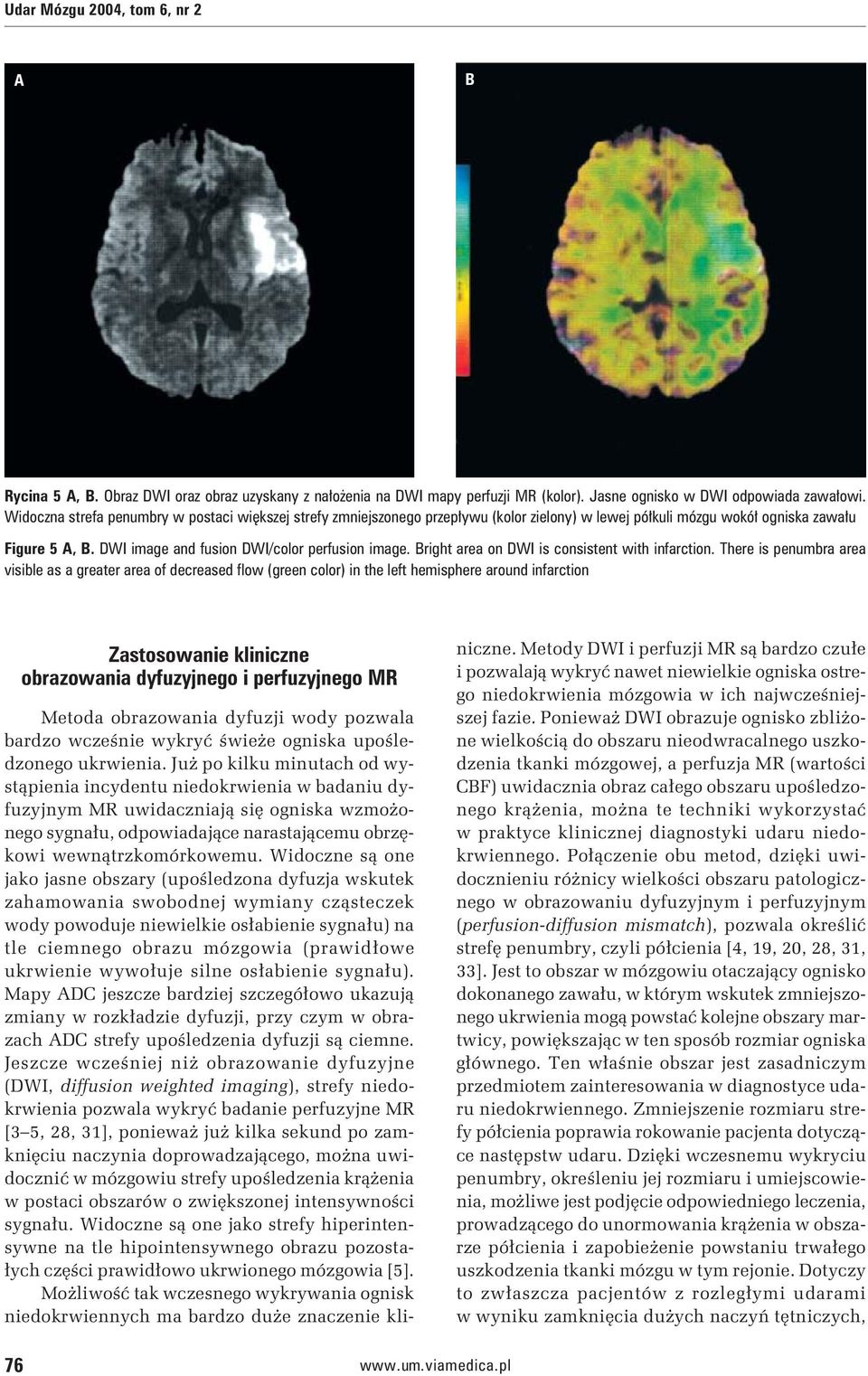 Bright area on DWI is consistent with infarction.