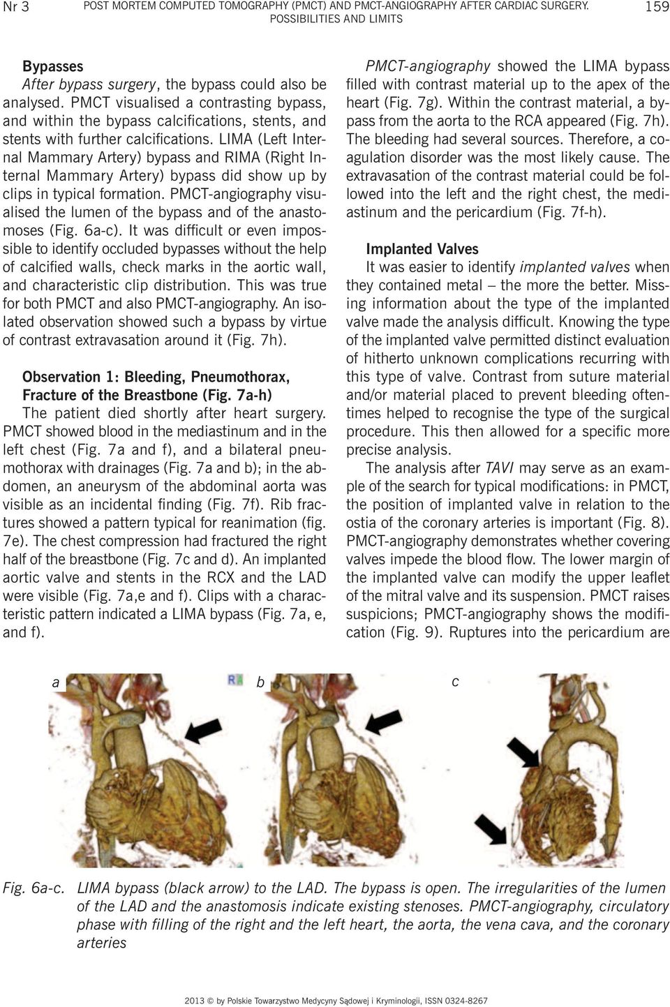 LIMA (Left Internal Mammary Artery) bypass and RIMA (Right Internal Mammary Artery) bypass did show up by clips in typical formation.