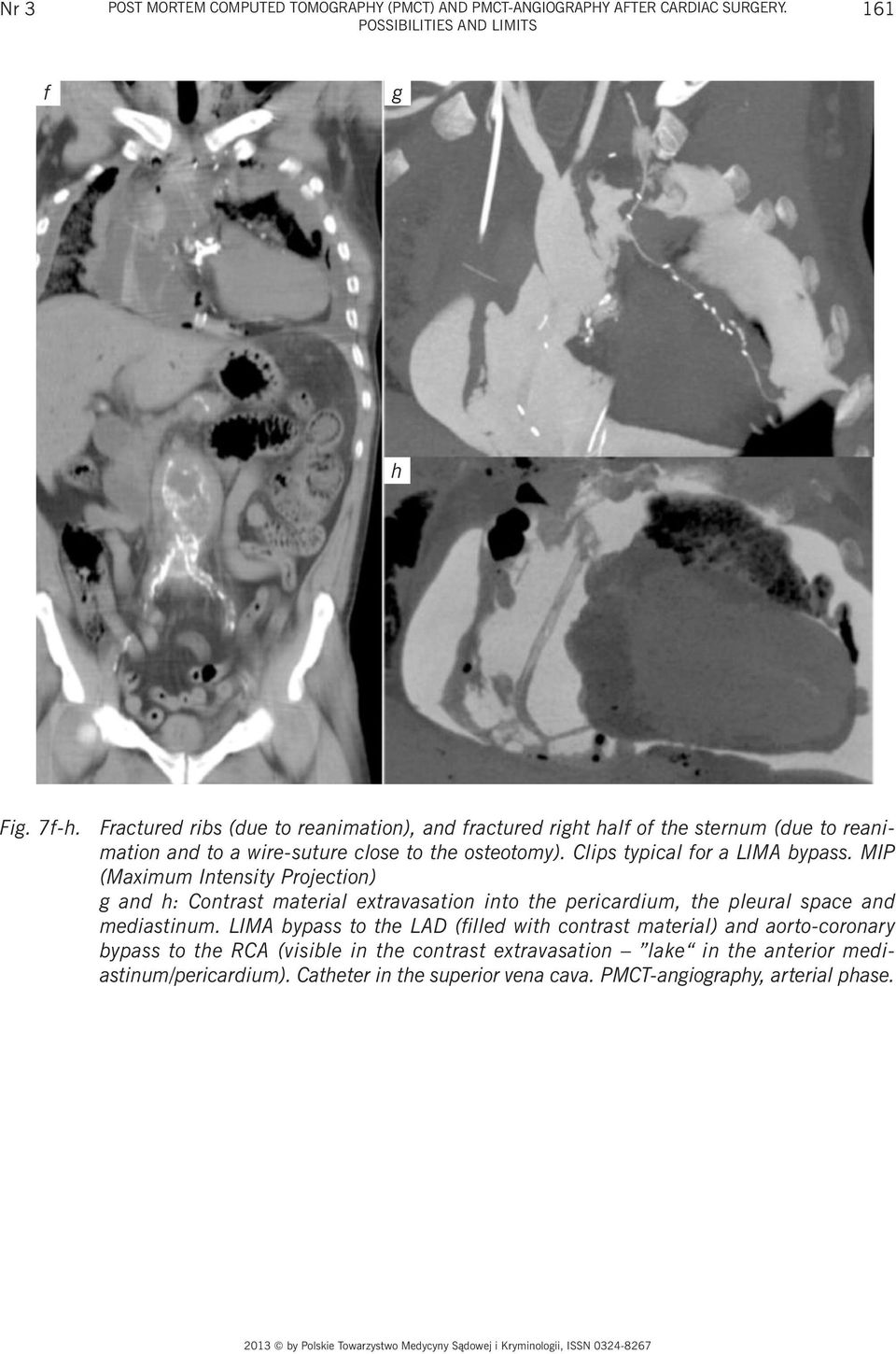 Clips typical for a LIMA bypass. MIP (Maximum Intensity Projection) g and h: Contrast material extravasation into the pericardium, the pleural space and mediastinum.