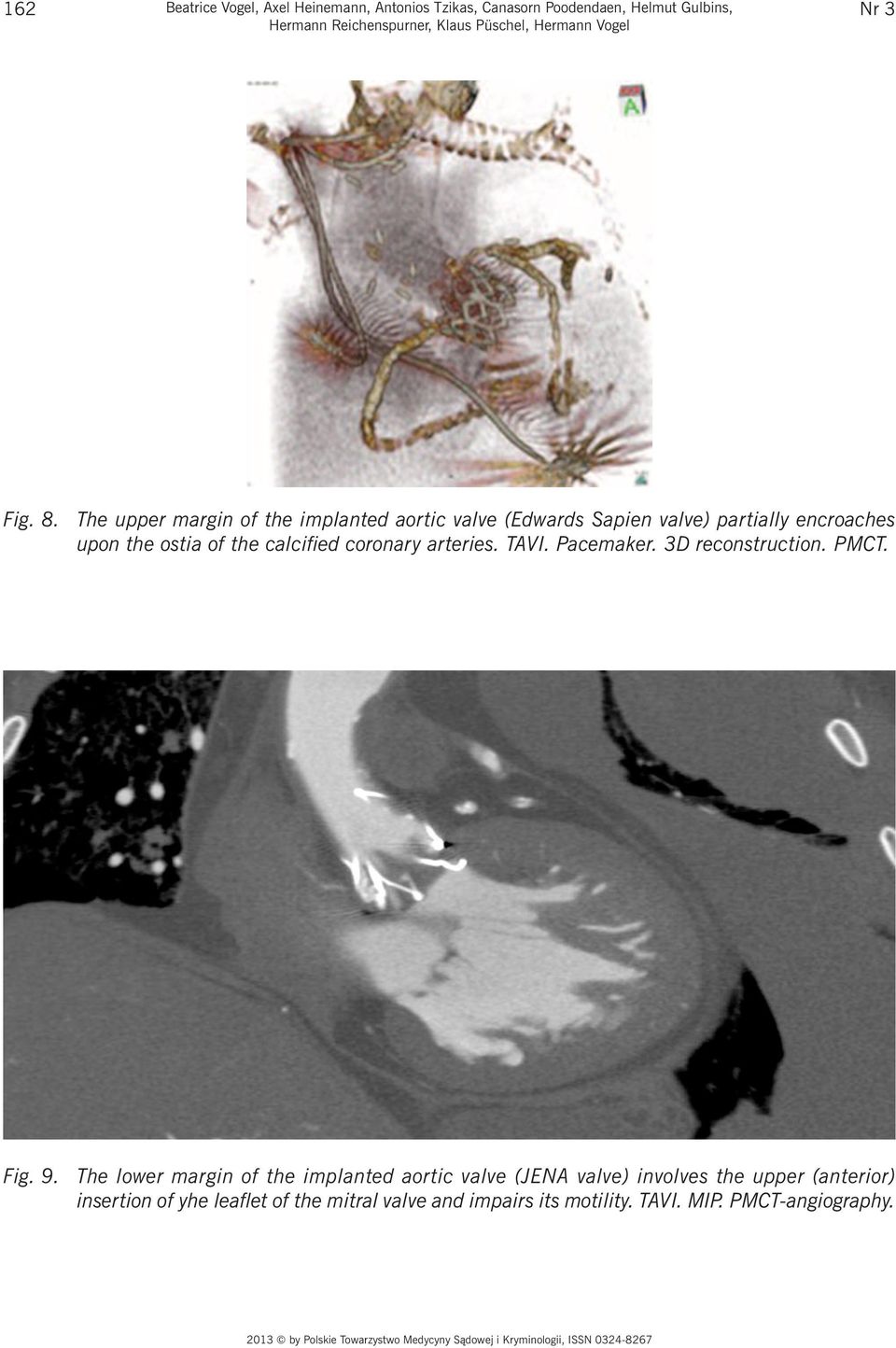 The upper margin of the implanted aortic valve (Edwards Sapien valve) partially encroaches upon the ostia of the calcified coronary