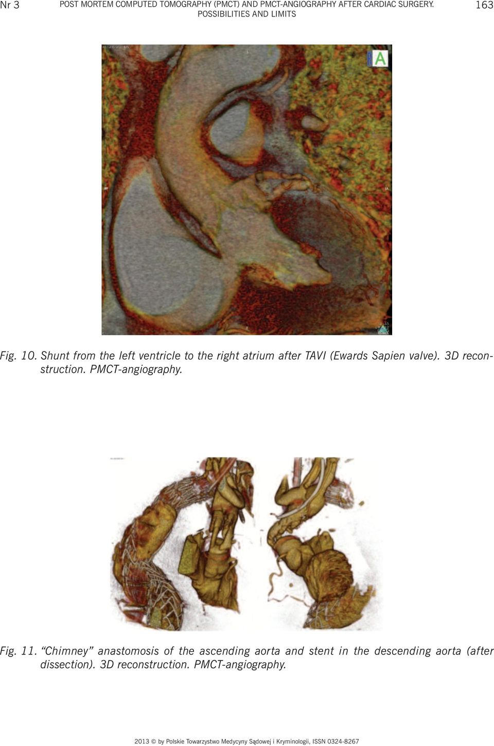 Shunt from the left ventricle to the right atrium after TAVI (Ewards Sapien valve).