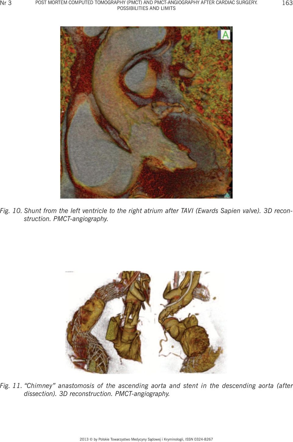 Shunt from the left ventricle to the right atrium after TAVI (Ewards Sapien valve).