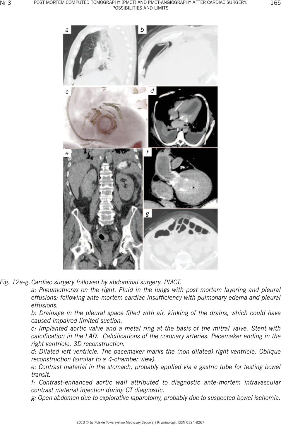 b: Drainage in the pleural space filled with air, kinking of the drains, which could have caused impaired limited suction. c: Implanted aortic valve and a metal ring at the basis of the mitral valve.