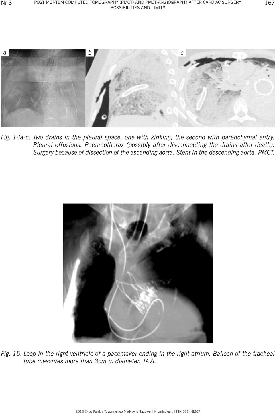 Pneumothorax (possibly after disconnecting the drains after death). Surgery because of dissection of the ascending aorta.