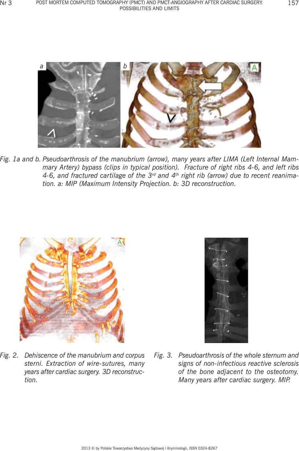 Fracture of right ribs 4-6, and left ribs 4-6, and fractured cartilage of the 3 rd and 4 th right rib (arrow) due to recent reanimation. a: MIP (Maximum Intensity Projection.