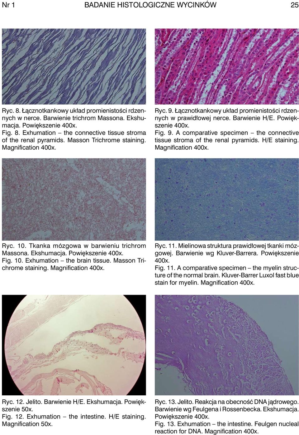 H/E staining. Magnification Ryc. 10. Tkanka mózgowa w barwieniu trichrom Massona. Ekshumacja. Powiększenie Fig. 10. Exhumation the brain tissue. Masson Trichrome staining. Magnification Ryc. 11.