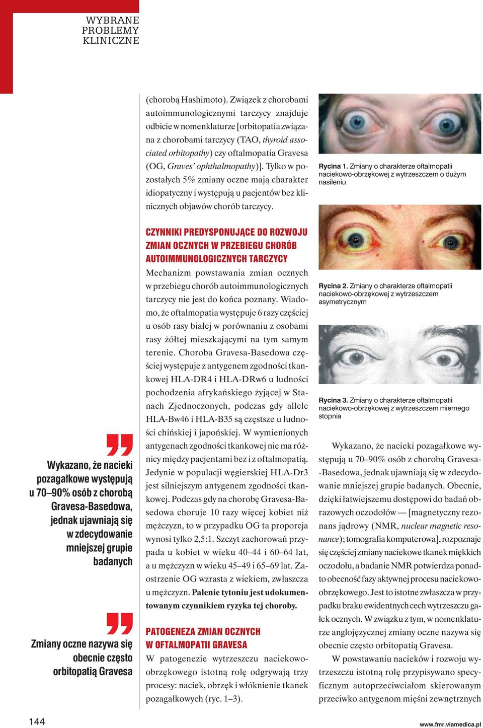 Tylko w pozostałych 5% zmiany oczne mają charakter idiopatyczny i występują u pacjentów bez klinicznych objawów chorób tarczycy. Rycina 1.