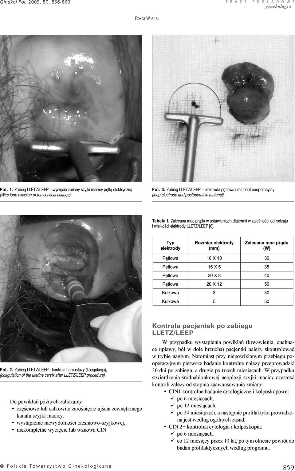 Fot. 2. Zabieg - kontrola hemostazy (koagulacja), (coagulation of the uterine cervix after procedure).