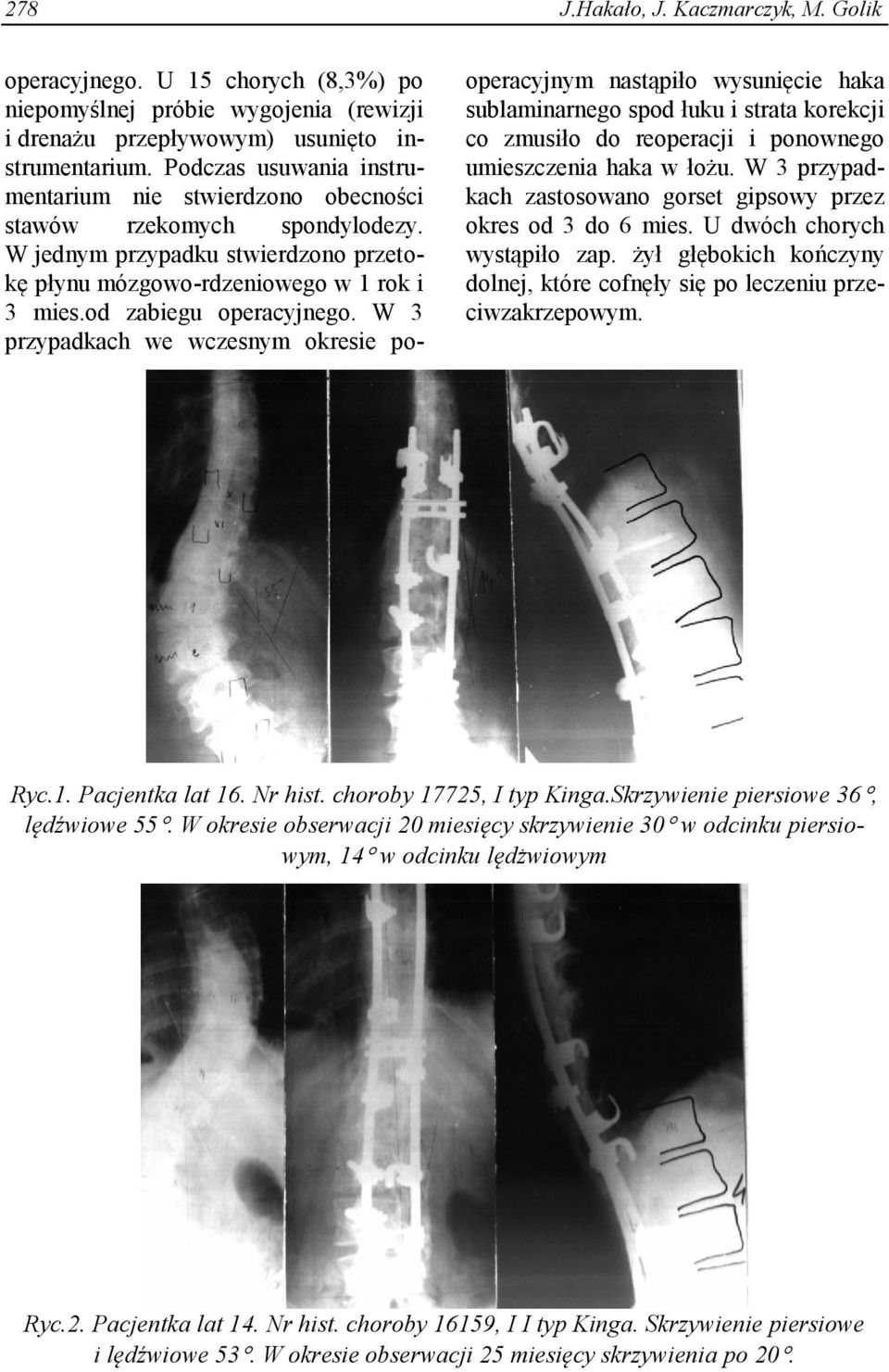 W 3 przypadkach we wczesnym okresie pooperacyjnym nastąpiło wysunięcie haka sublaminarnego spod łuku i strata korekcji co zmusiło do reoperacji i ponownego umieszczenia haka w łożu.