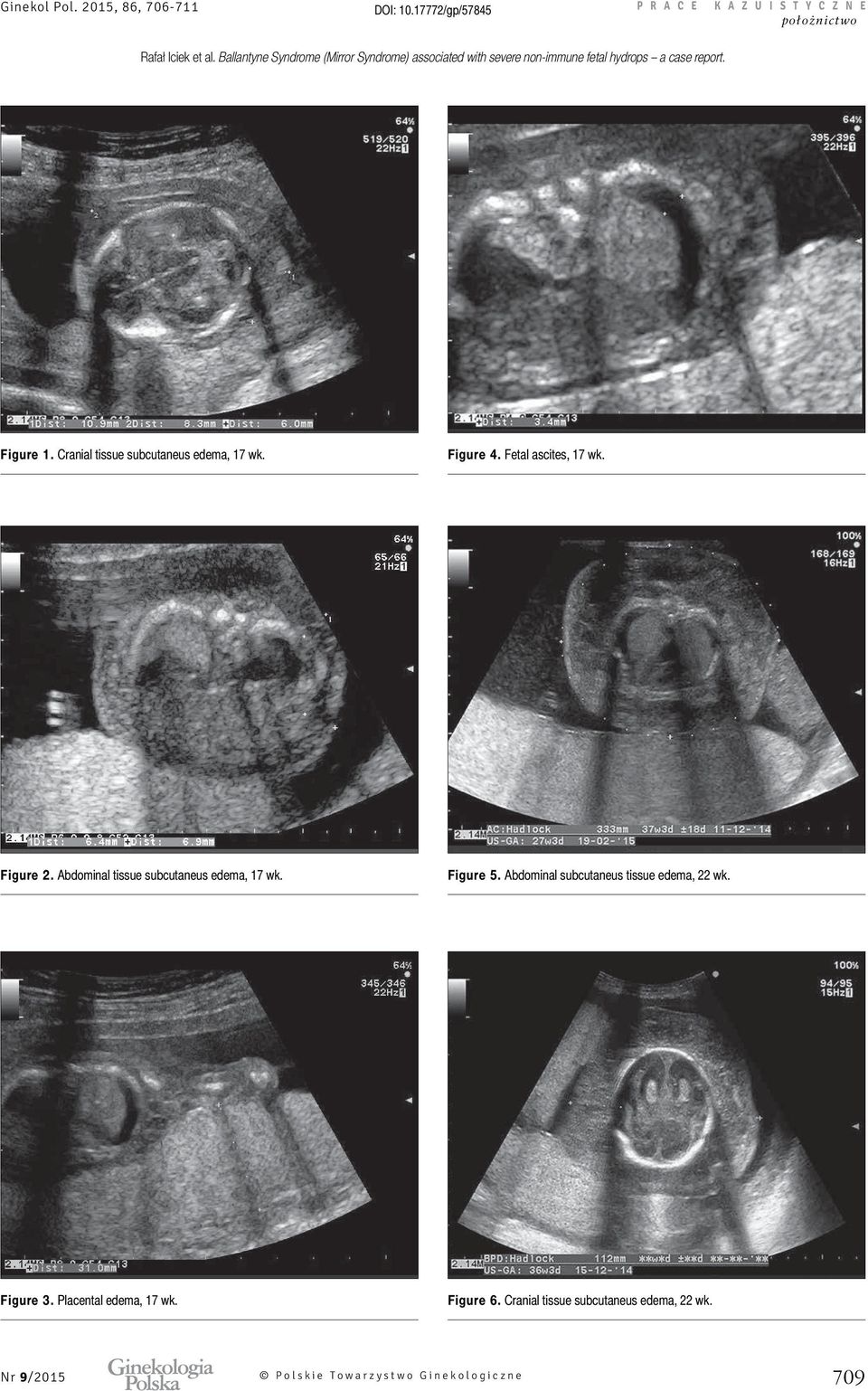 Abdominal tissue subcutaneus edema, 17 wk. Figure 5. Abdominal subcutaneus tissue edema, 22 wk.