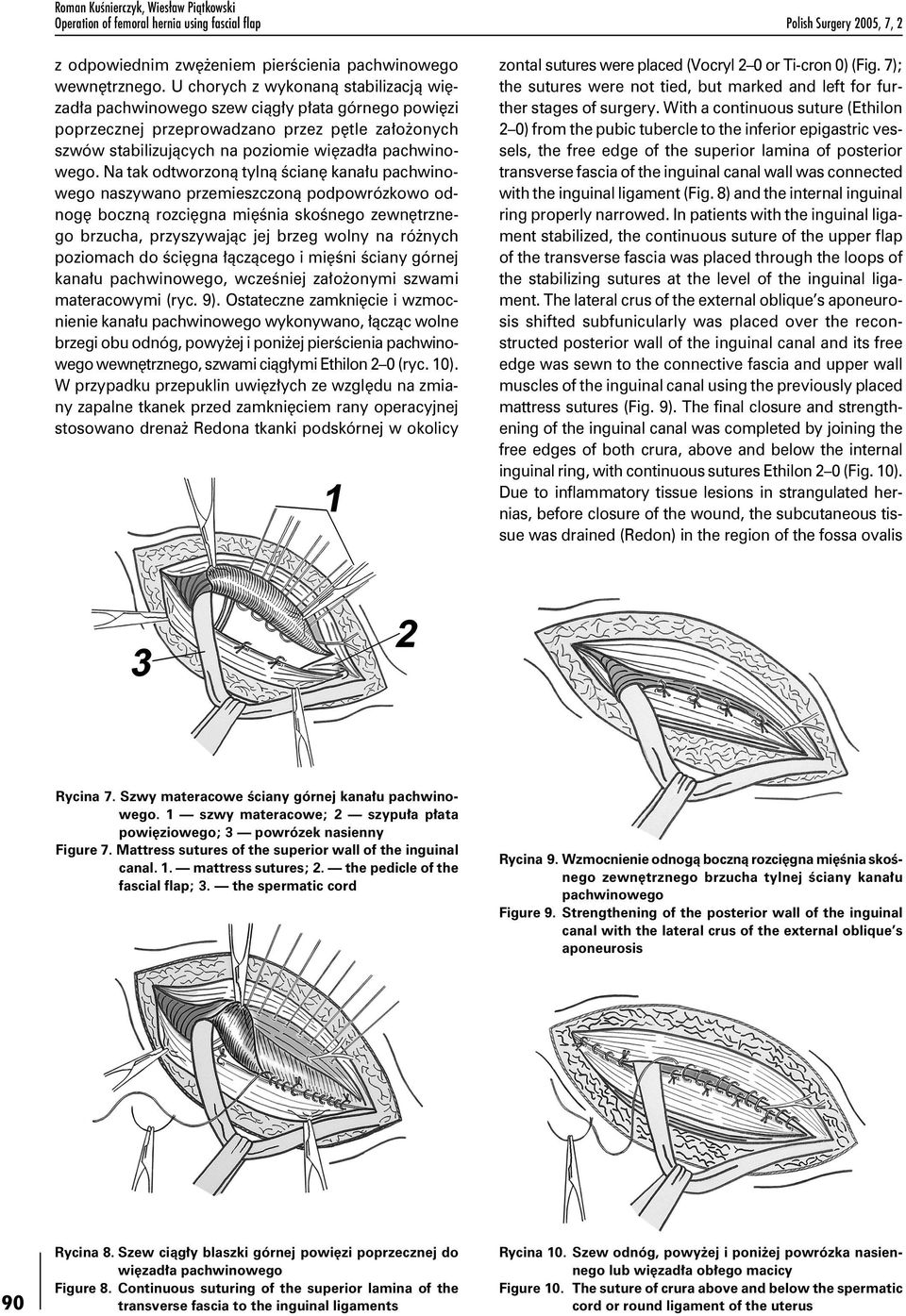 Na tak odtworzoną tylną ścianę kanału pachwinowego naszywano przemieszczoną podpowrózkowo odnogę boczną rozcięgna mięśnia skośnego zewnętrznego brzucha, przyszywając jej brzeg wolny na różnych