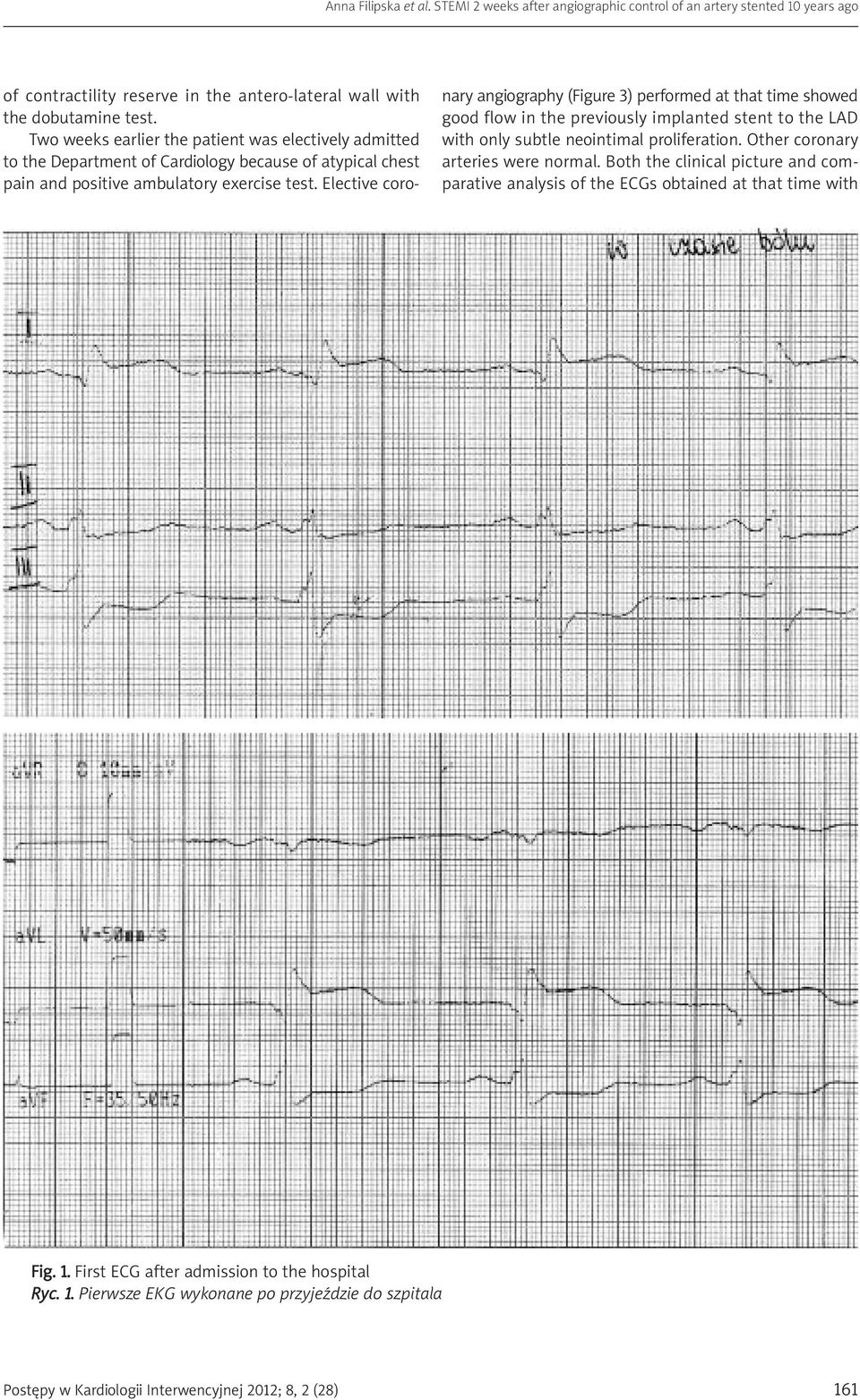 Elective coronary angiography (Figure 3) performed at that time showed good flow in the previously implanted stent to the LAD with only subtle neointimal proliferation.