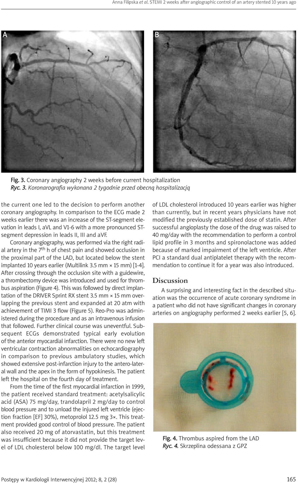 Coronary angiography, was performed via the right radial artery in the 7 th h of chest pain and showed occlusion in the proximal part of the LAD, but located below the stent implanted 10 years