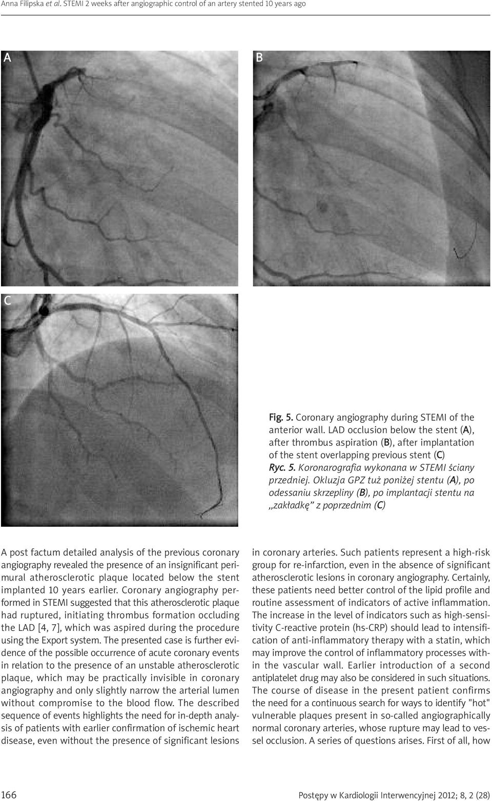 Okluzja GPZ tuż poniżej stentu (A), po odessaniu skrzepliny (B), po implantacji stentu na,,zakładkę z poprzednim (C) A post factum detailed analysis of the previous coronary angiography revealed the