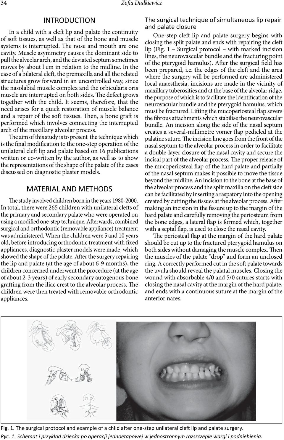 In the case of a bilateral cleft, the premaxilla and all the related structures grow forward in an uncontrolled way, since the nasolabial muscle complex and the orbicularis oris muscle are