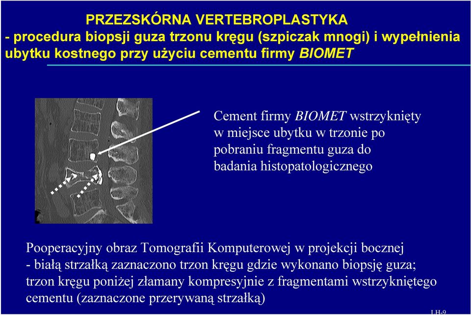 Pooperacyjny obraz Tomografii Komputerowej w projekcji bocznej -białą strzałką zaznaczono trzon kręgu gdzie wykonano