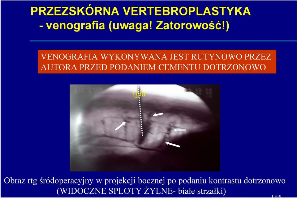 PODANIEM CEMENTU DOTRZONOWO igła Obraz rtg śródoperacyjny w