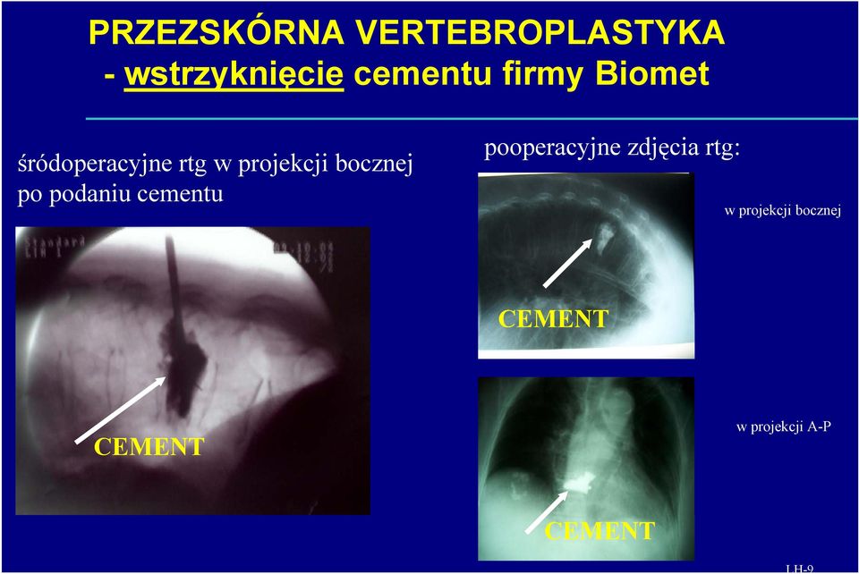 podaniu cementu pooperacyjne zdjęcia rtg: w