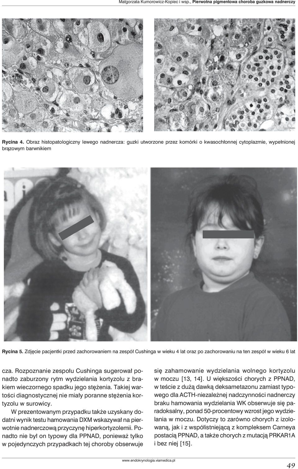 Zdjęcie pacjentki przed zachorowaniem na zespół Cushinga w wieku 4 lat oraz po zachorowaniu na ten zespół w wieku 6 lat cza.
