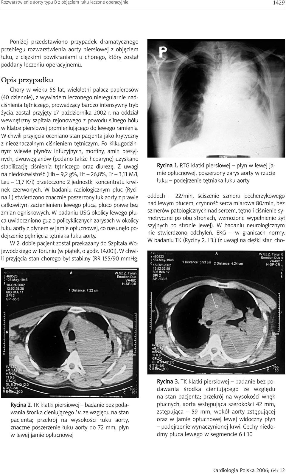 Opis przypadku Chory w wieku 56 lat, wieloletni palacz papierosów (40 dziennie), z wywiadem leczonego nieregularnie nadciśnienia tętniczego, prowadzący bardzo intensywny tryb życia, został przyjęty