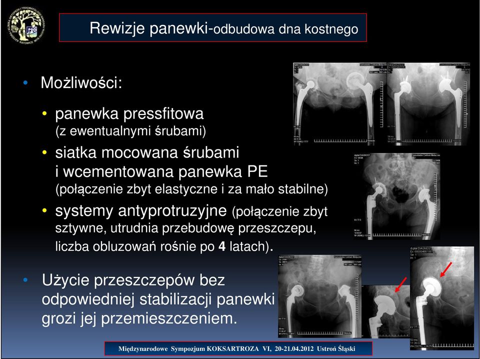 systemy antyprotruzyjne (połączenie zbyt sztywne, utrudnia przebudowę przeszczepu, liczba obluzowań