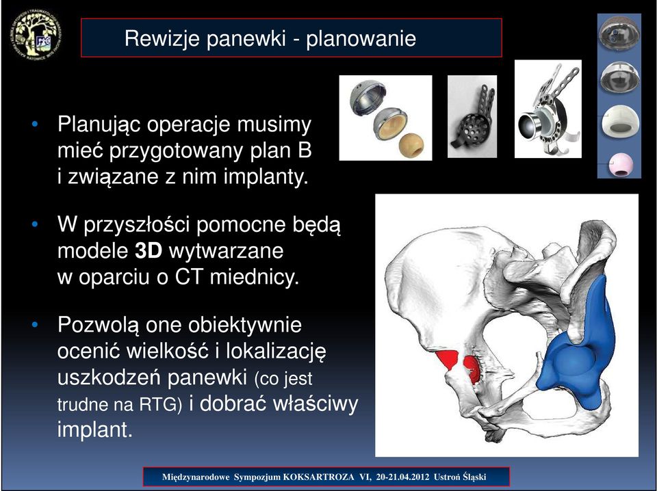 W przyszłości pomocne będą modele 3D wytwarzane w oparciu o CT miednicy.