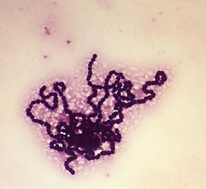 Etiologia a wiek dziecka 1-21 dni Najczęściej etiologia bakteryjna GBS (Streptococcus