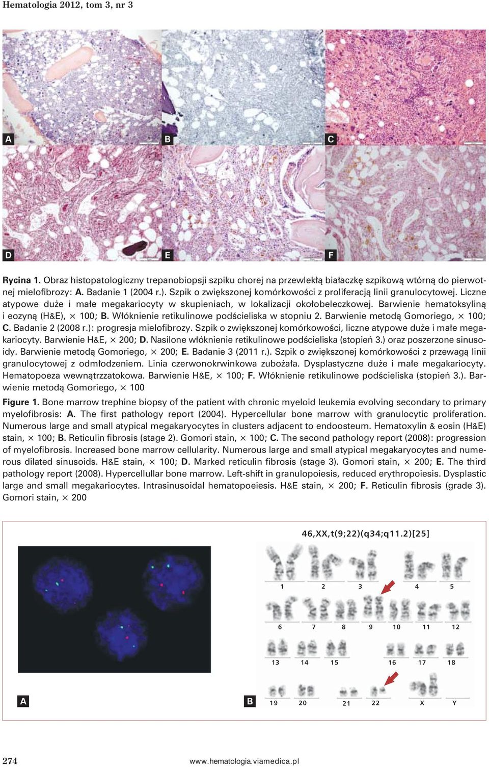 Barwienie hematoksyliną i eozyną (H&E), 100; B. Włóknienie retikulinowe podścieliska w stopniu 2. Barwienie metodą Gomoriego, 100; C. Badanie 2 (2008 r.): progresja mielofibrozy.