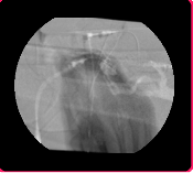 MYŚLENIE Podstawy ochrony radiologicznej w radiologii zabiegowej MYŚLENIE B 007 Świadome użycie procedur specjalnych zwracanie uwagi na sygnały upływu czasu skopii stosowanie Listy Kontrolnej